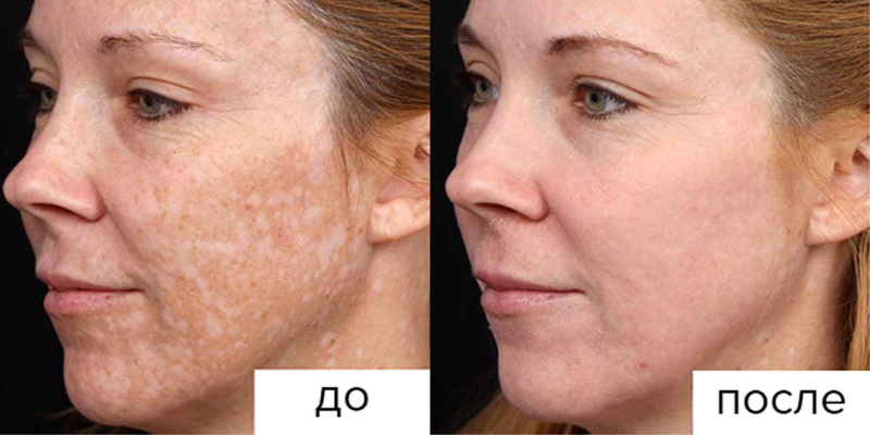 Ультразвуковой пилинг кожи лица – приятная и полезная процедура для вашей кожи